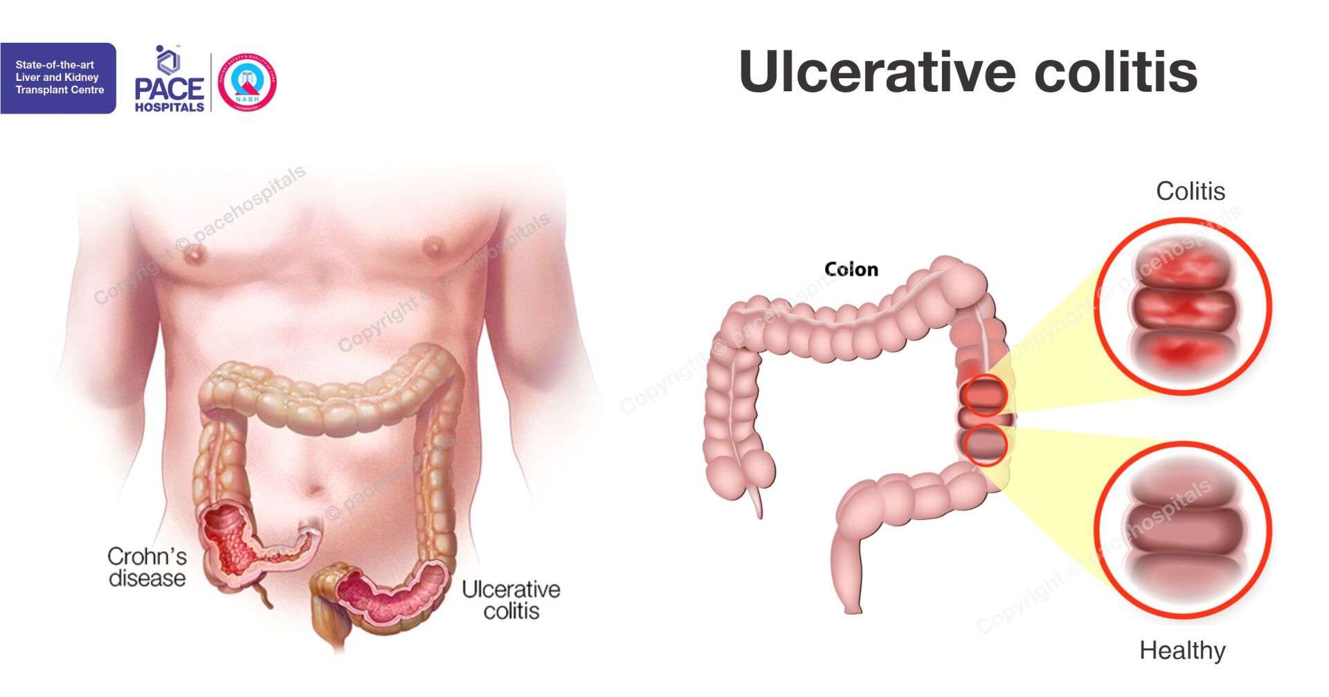 Ulcerative colitis: causes, symptoms, complications and ...