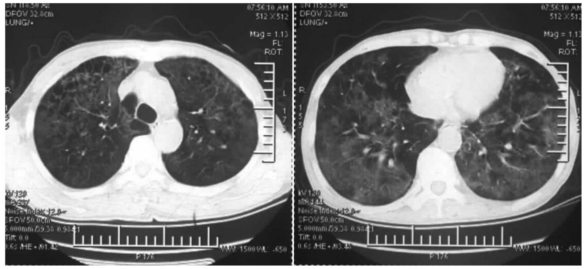 Ulcerative colitis combined with acute interstitial lung ...