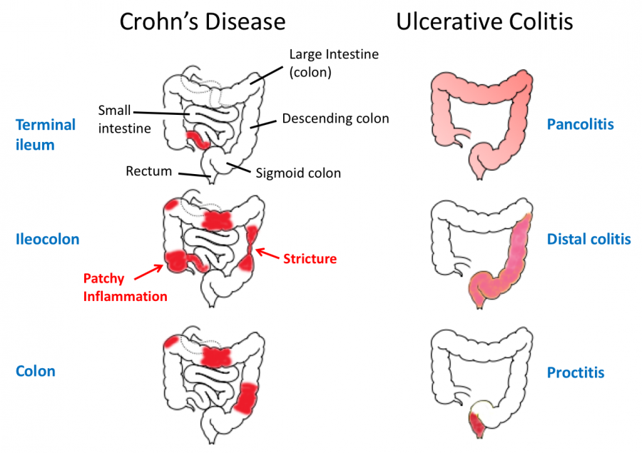 Ulcerative Colitis Cure