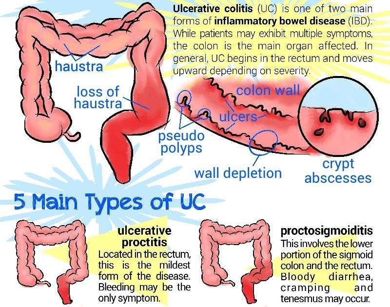 Ulcerative Colitis Diet To Lose Weight