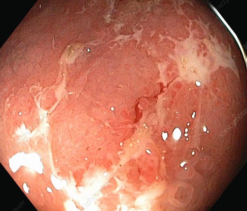 Ulcerative colitis, endoscopic view