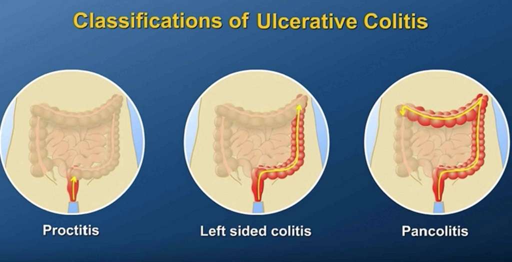 Ulcerative Colitis (IBD) and Menstrual Cycle