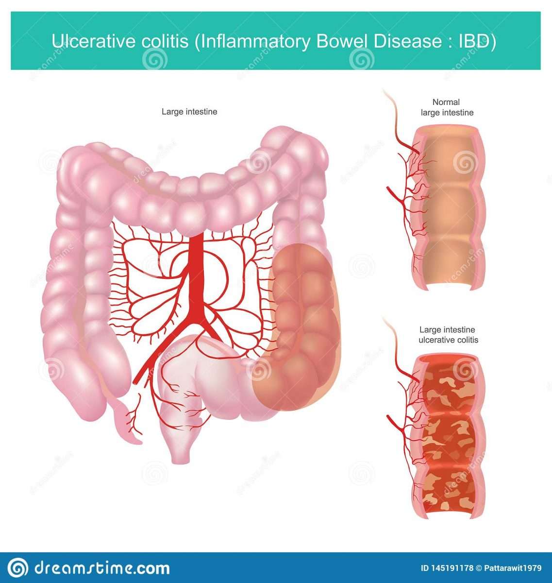 Ulcerative Colitis. Illustration Graphic. Stock Vector