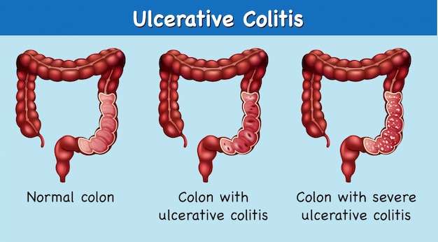 Ulcerative Colitis Images