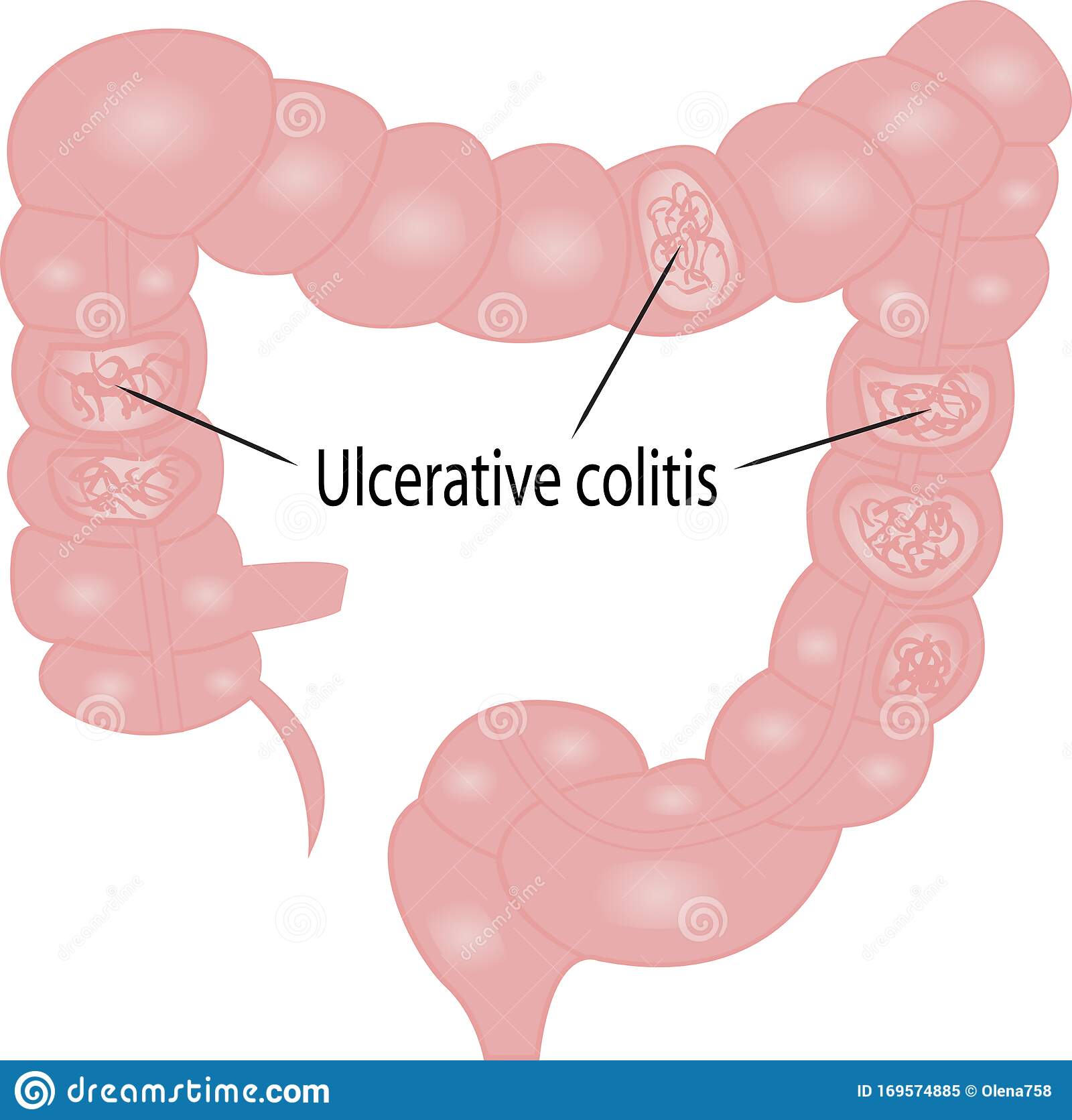 Ulcerative Colitis Intestine Disease Stock Vector