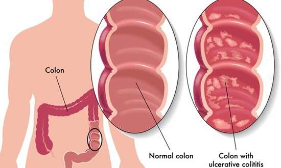 Ulcerative Colitis: Symptoms, Causes and Natural Treatment