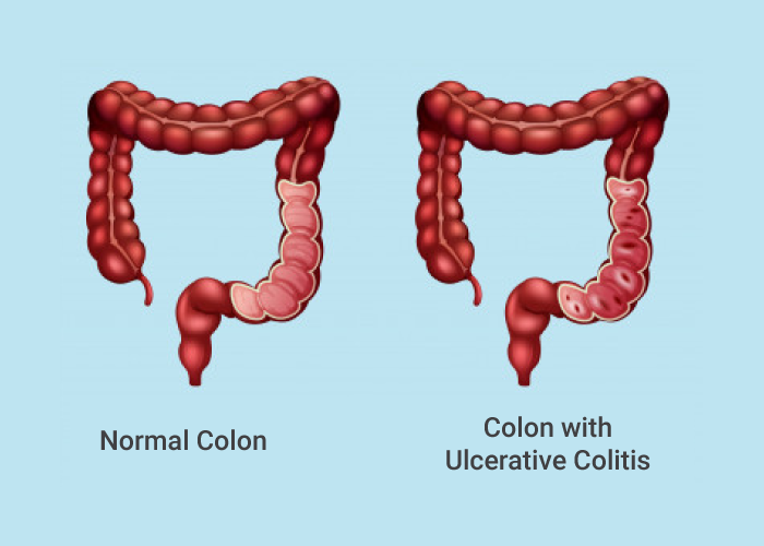 Ulcerative Colitis Symptoms, Causes, Treatment And Cure