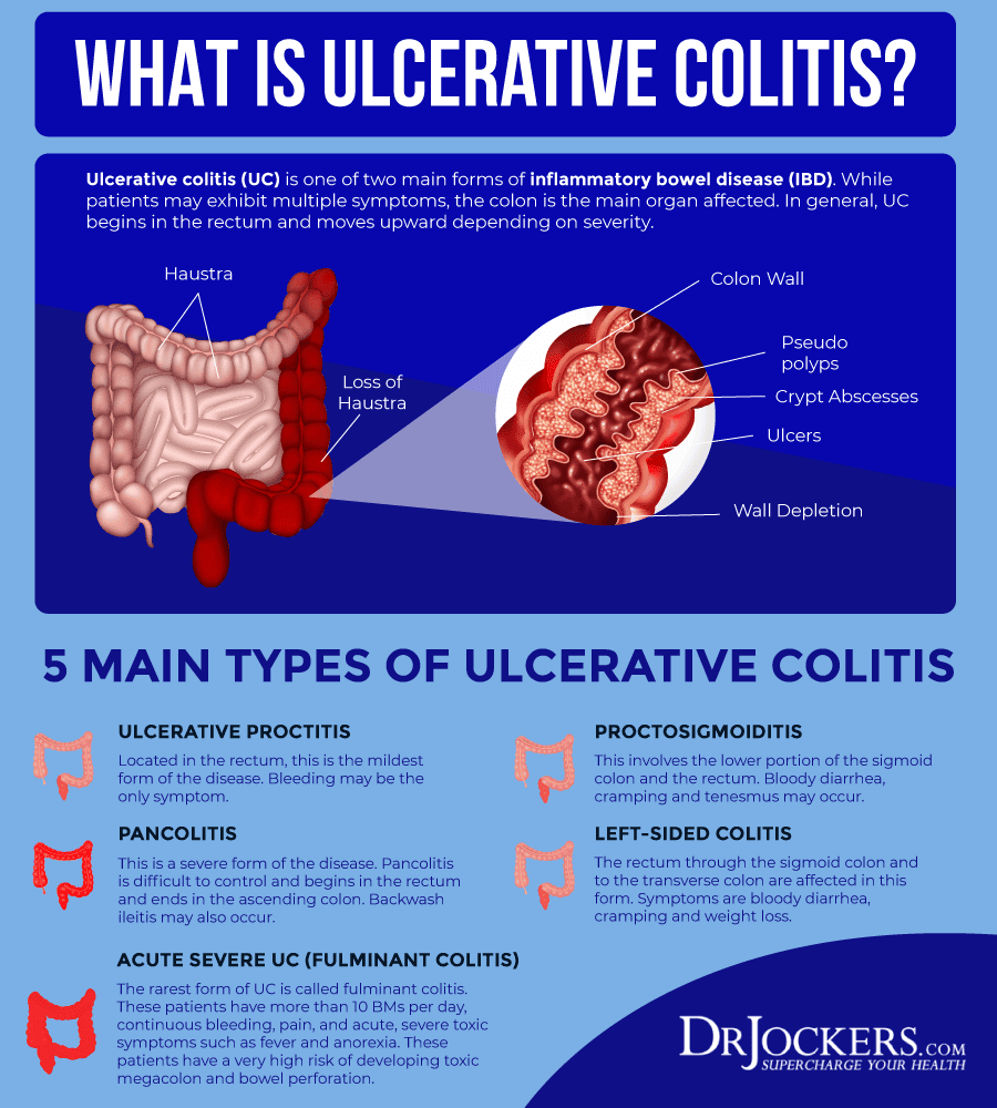 Ulcerative Colitis Symptoms