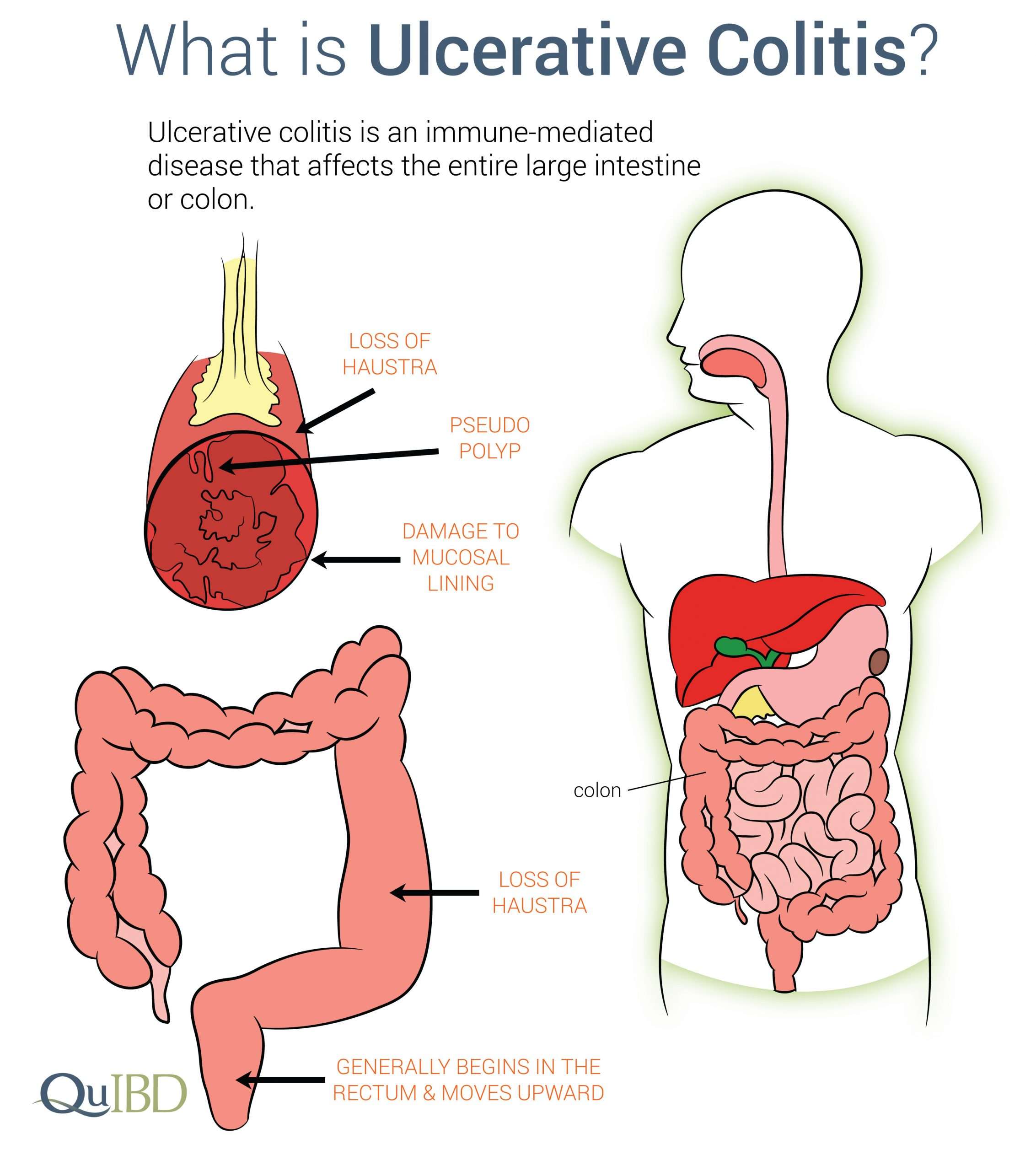 Ulcerative Colitis Symptoms IBD Prevalence Impact Causes