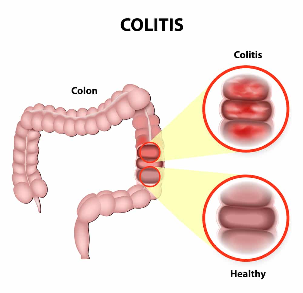 Ulcerative Colitis Symptoms &  Overview