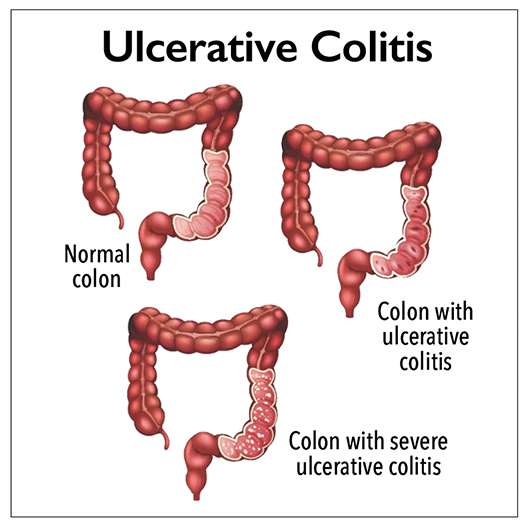 Ulcerative colitis