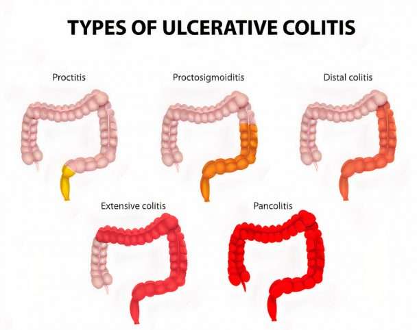Ulcerative Colitis (UC): Causes, Symptoms, Types ...