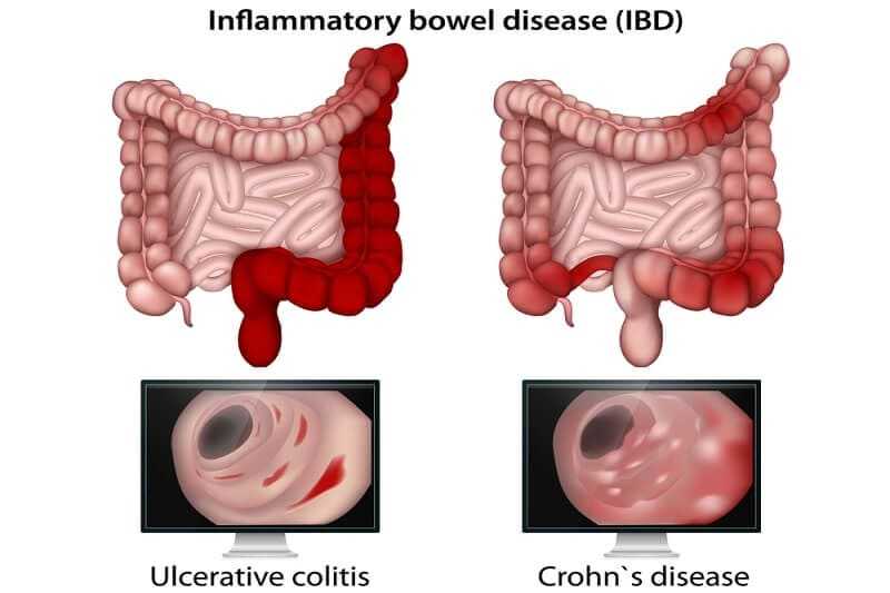 Ulcerative Colitis Vs Crohn