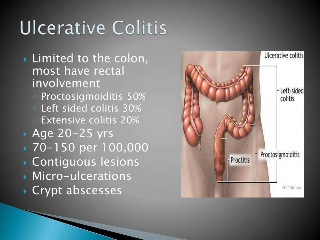 Ulcerative colitis weight loss: Malnutrition and IBD