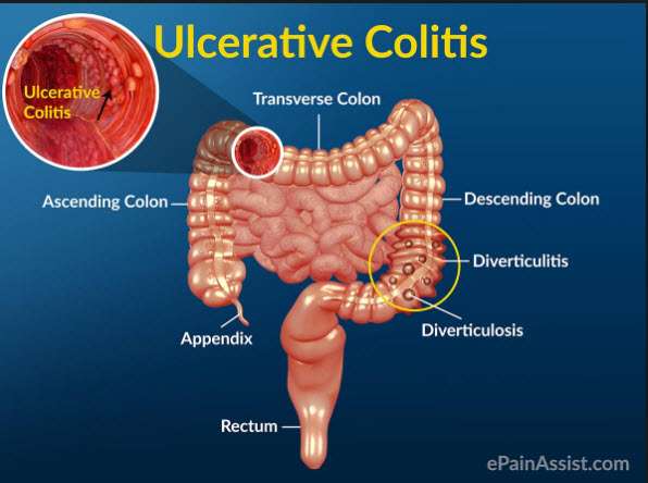 Ulcerative Colitis: What It Is, Causes, Symptoms, And ...