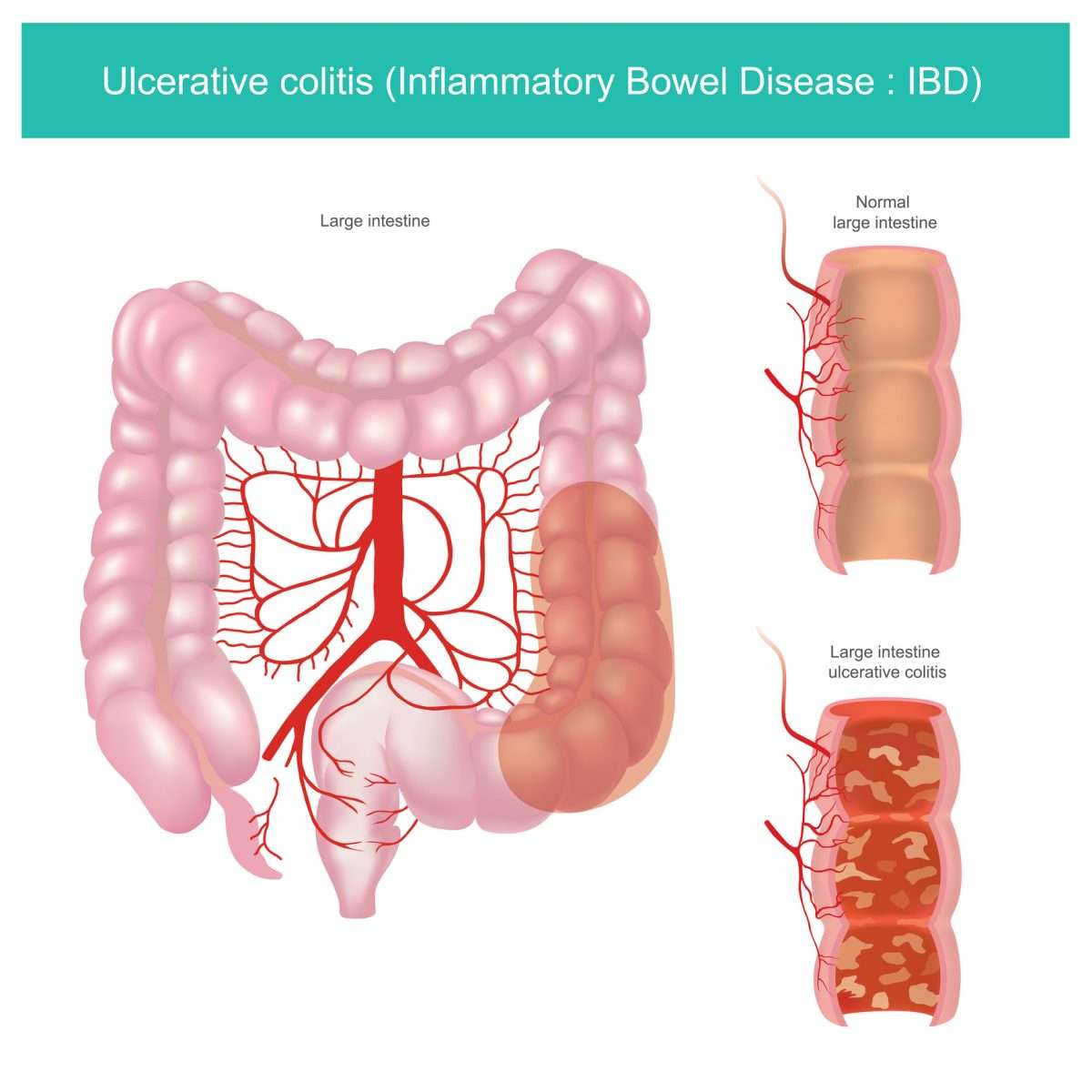 Ulcerative Colitis: What It Is, What It Isn