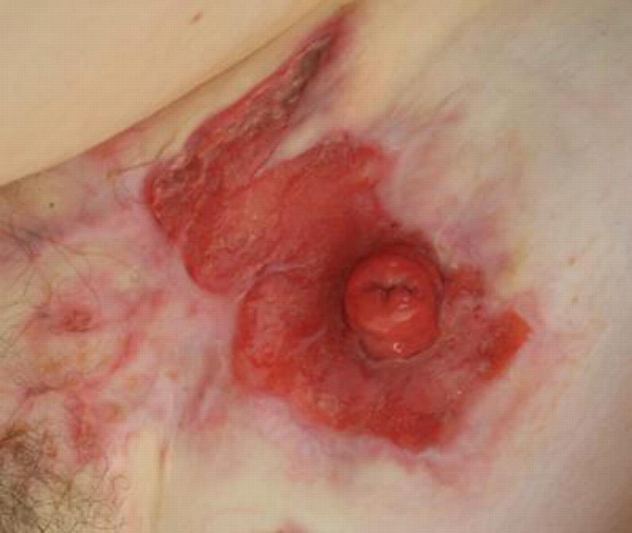 Ulcerative skin lesions in a child with colitis ulcerosa after ...