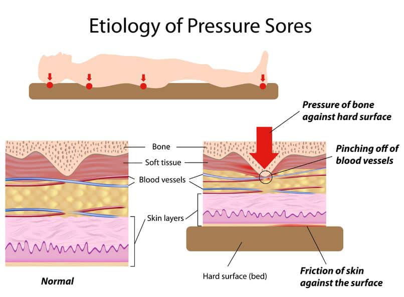 Understanding and Combating Pressure Ulcers