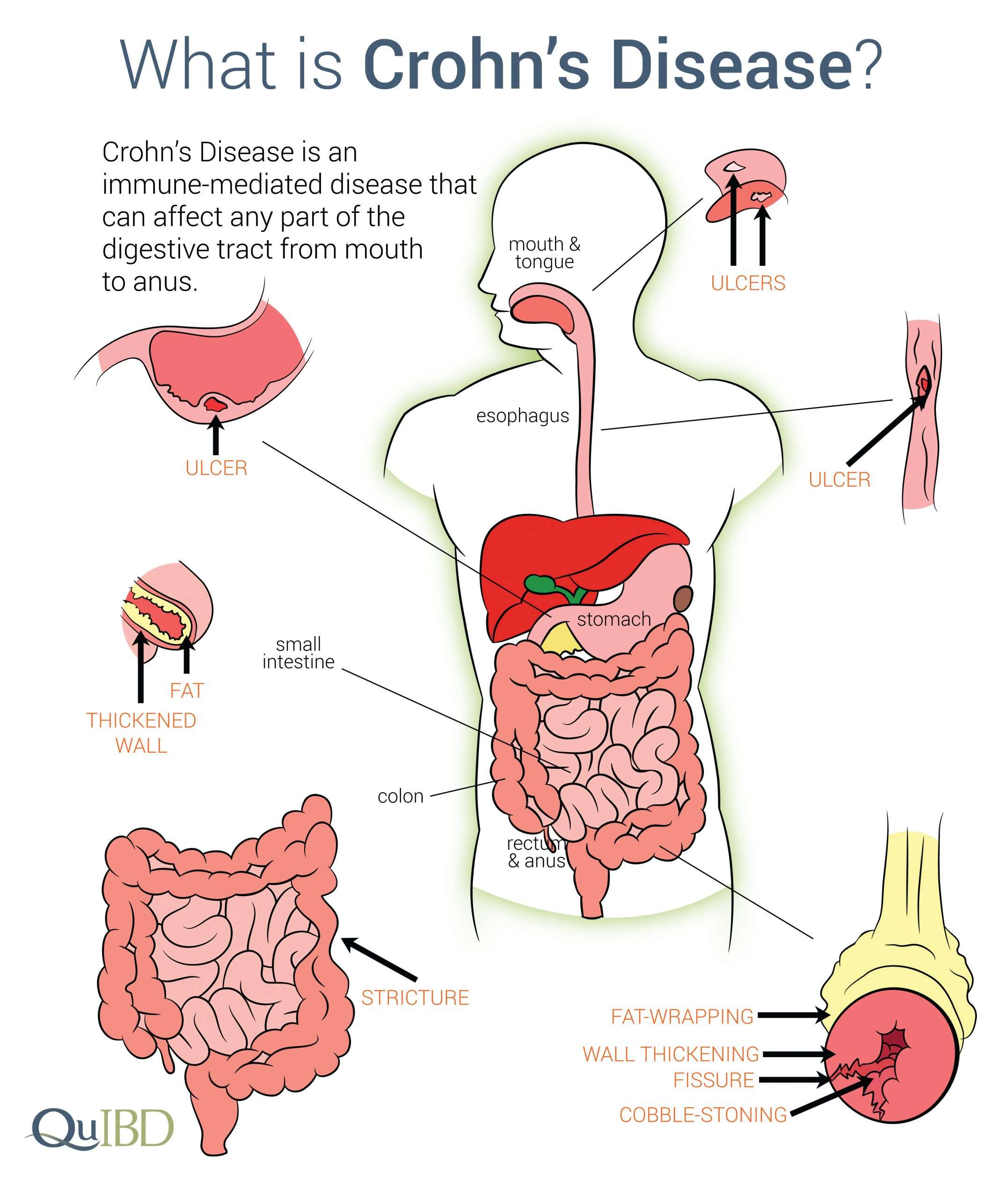 Understanding Crohns Disease