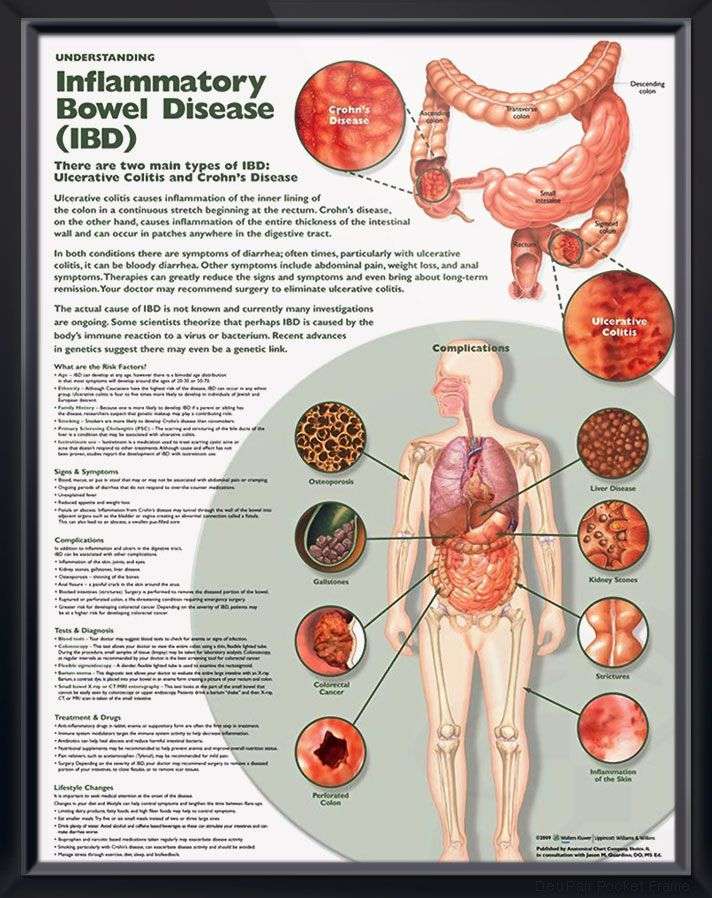 Understanding Inflammatory Bowel Disease Chart 20x26 ...