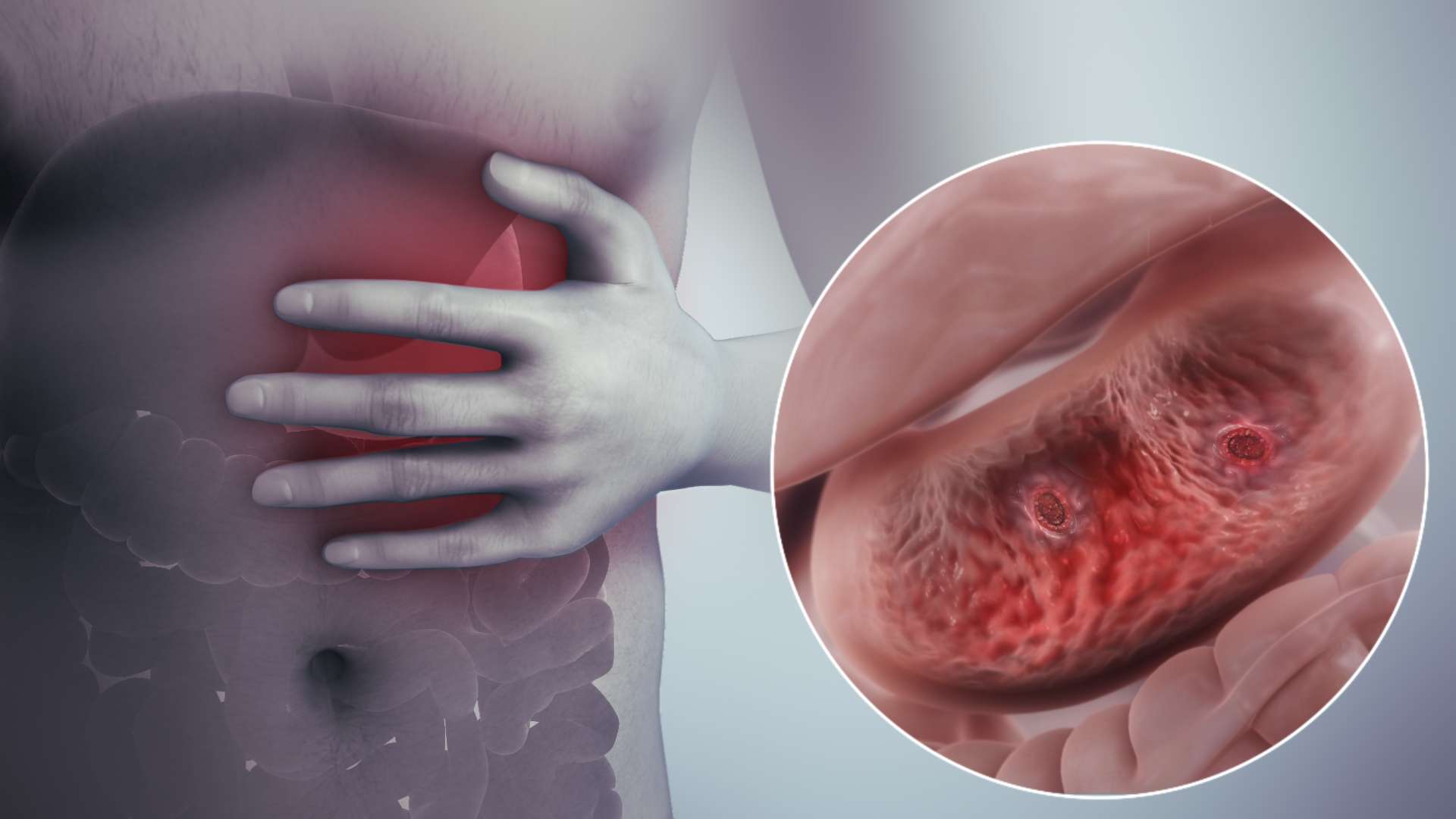 Various reasons for Stomach Ulcer