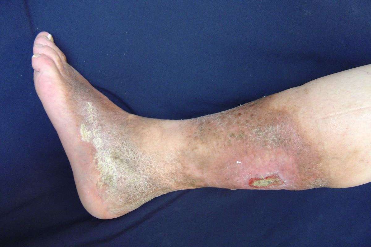 chronic-venous-insufficiency-ulcers