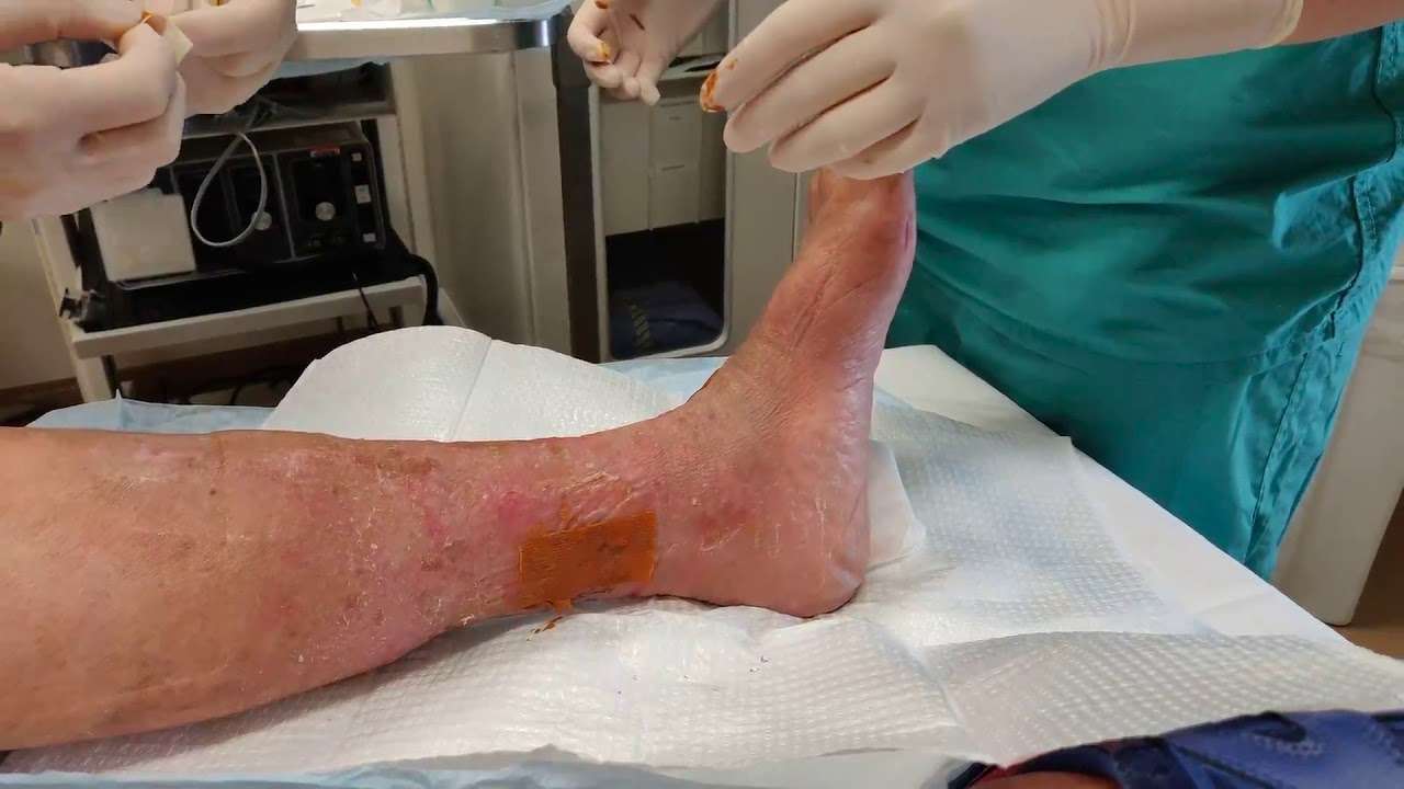 Venous Stasis Ulcer Bandaging and Dressing