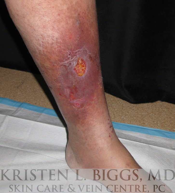 venous stasis ulcer picture