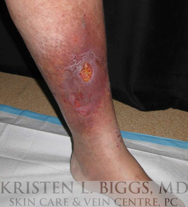 venous stasis ulcer pictures
