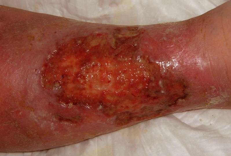 Venous Stasis Ulcer