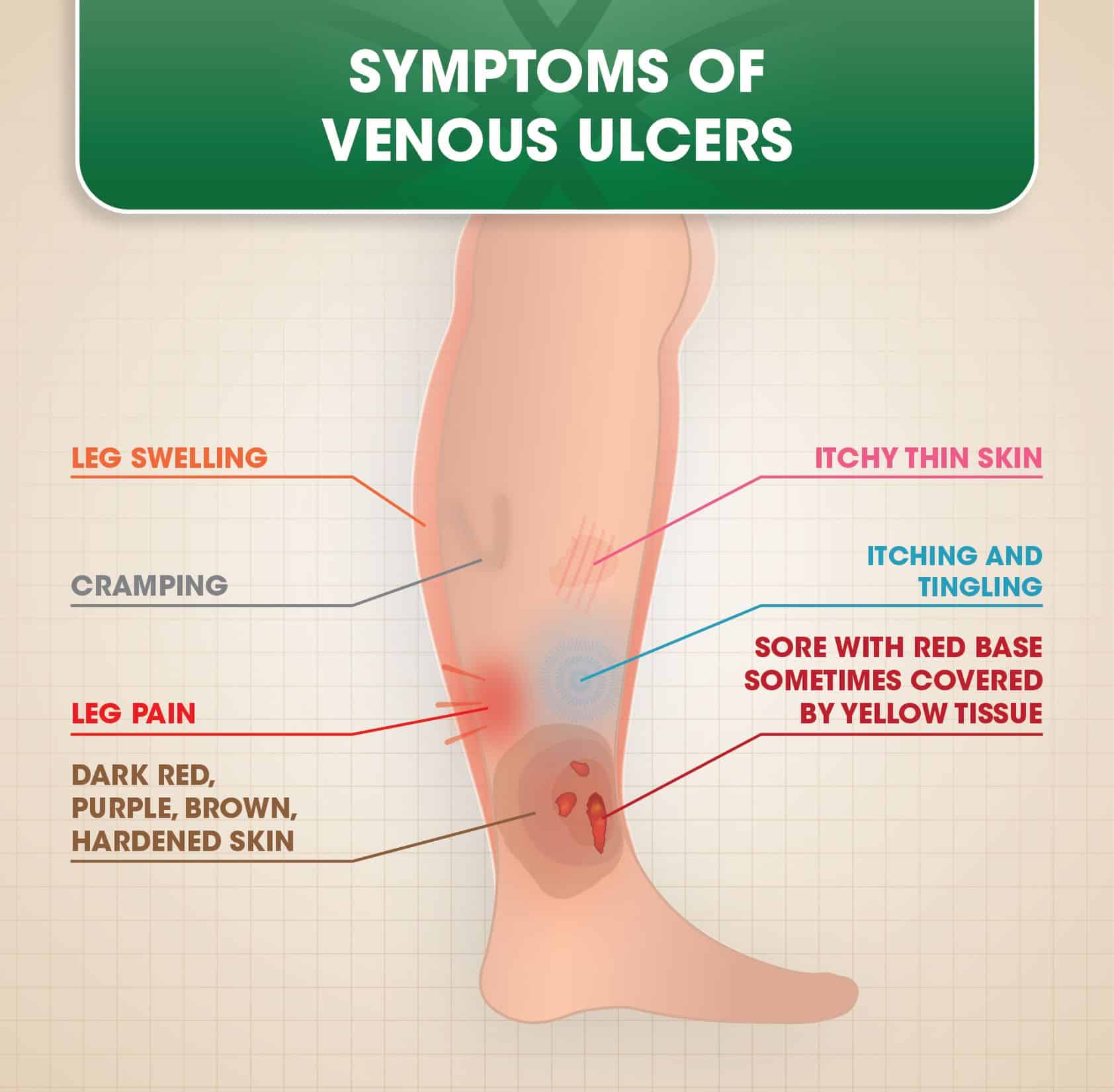 Venous Ulcers