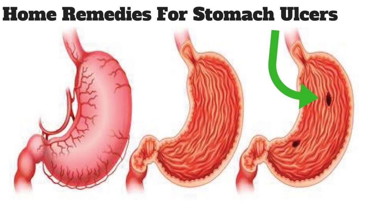 Very Effective 4 Home Remedies For Stomach Ulcers, No Side Effect ...