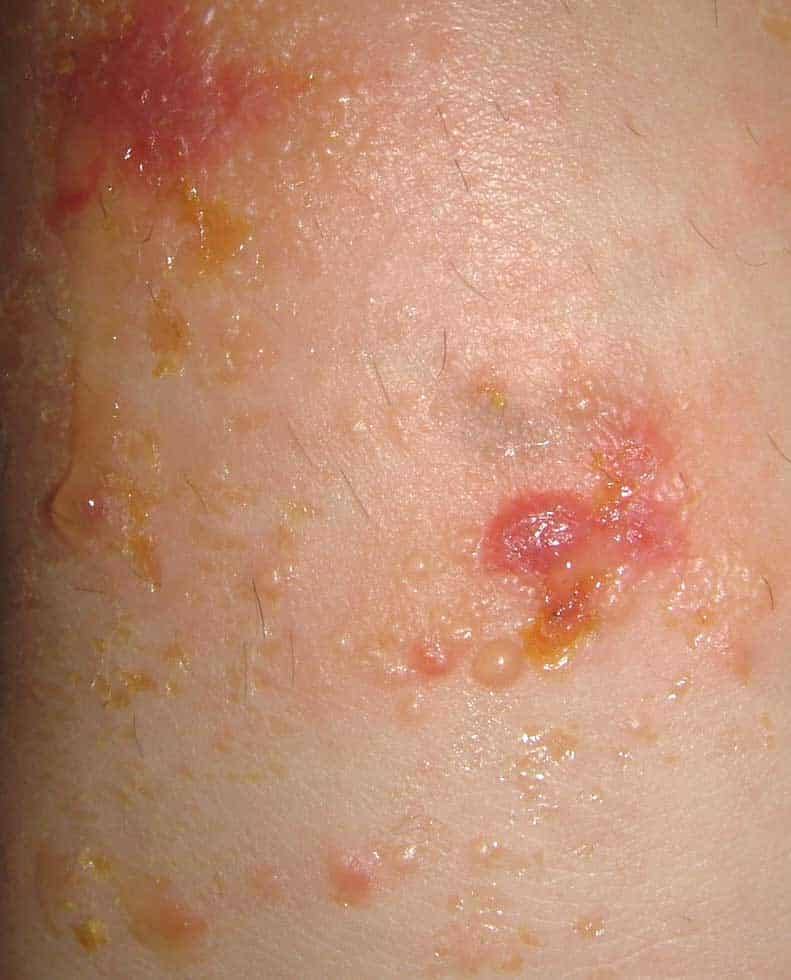 VIRTUAL GRAND ROUNDS IN DERMATOLOGY 2.0: Mystery Rash in Runners