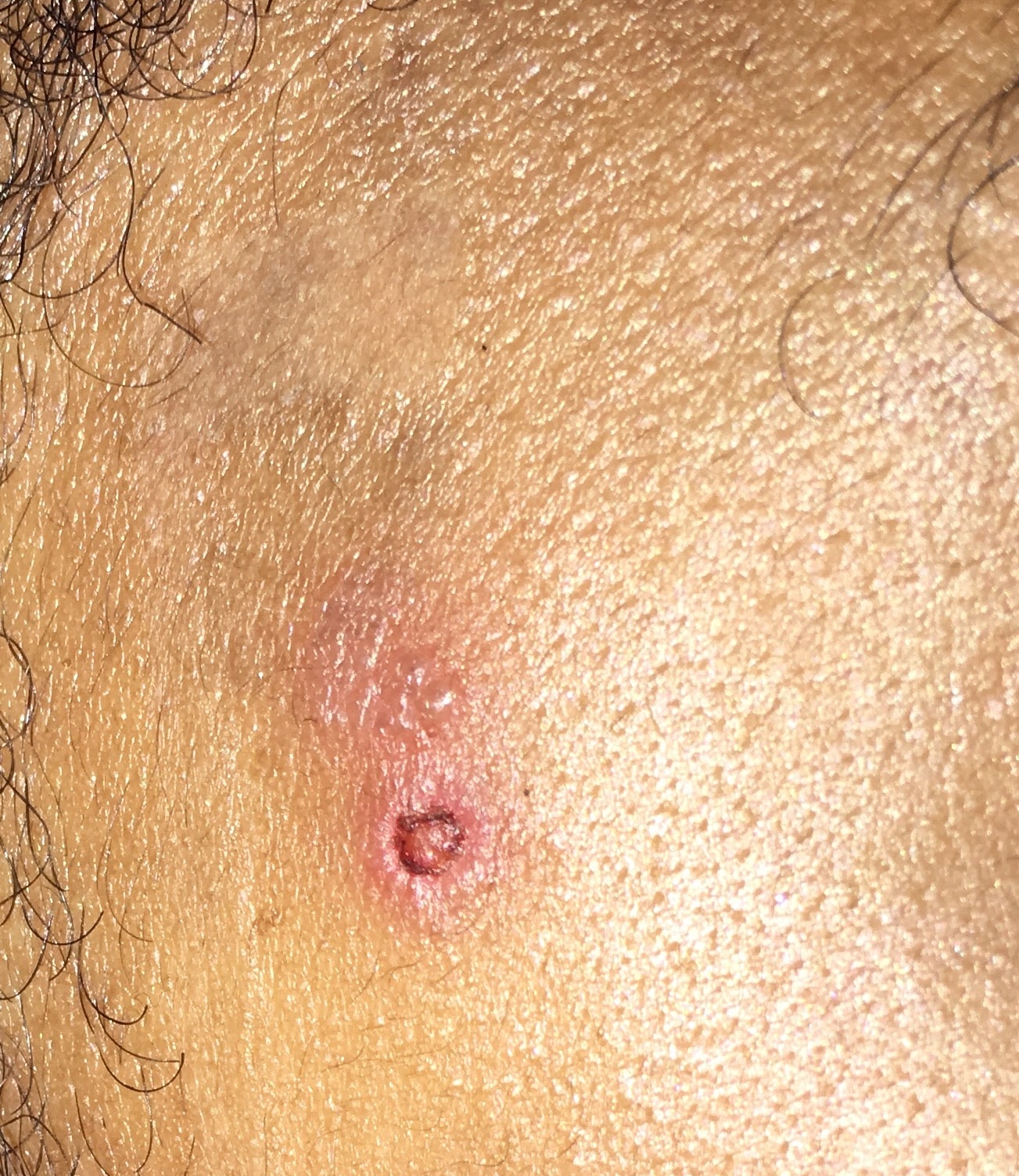 Weird rash/bump/ulcer on face
