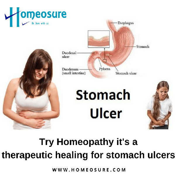 What are some natural remedies for stomach ulcers?