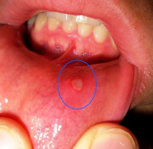What Can You Put On Mouth Ulcers