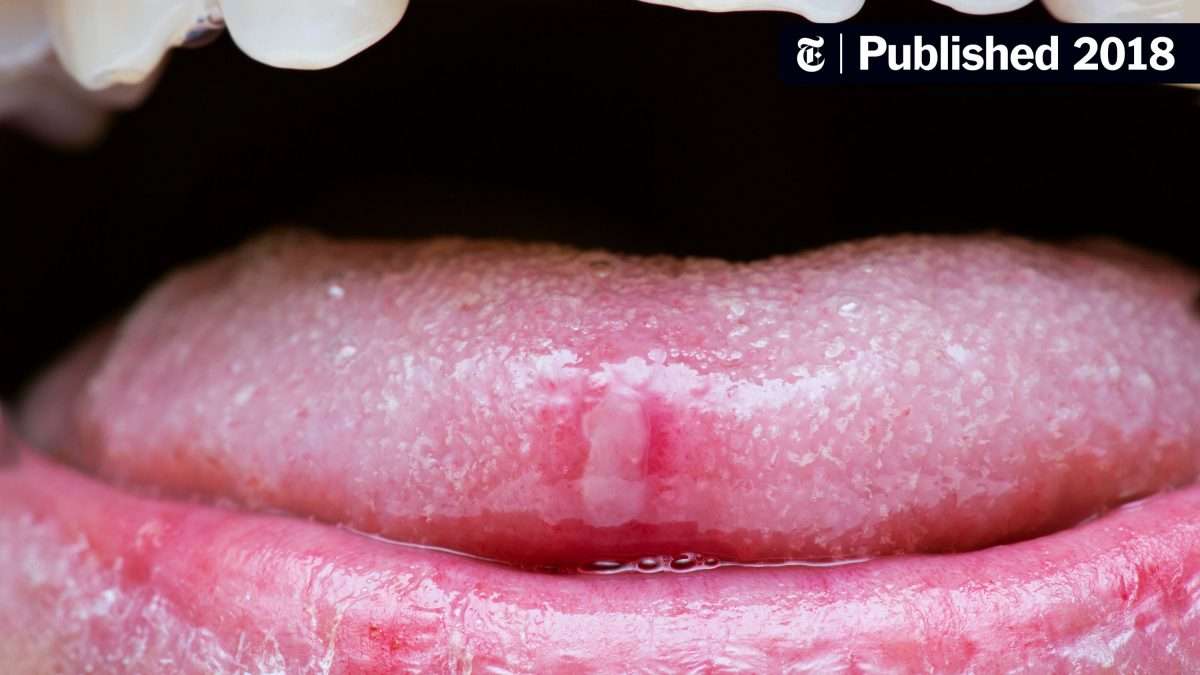 What Causes Canker Sores?