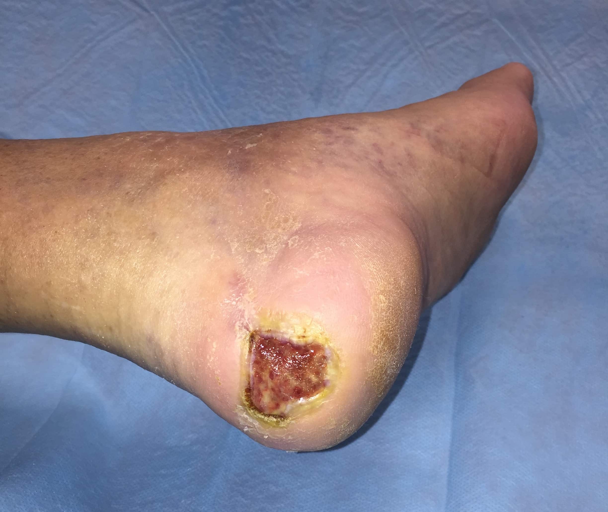 What causes diabetic foot ulcers and how do you manage them?