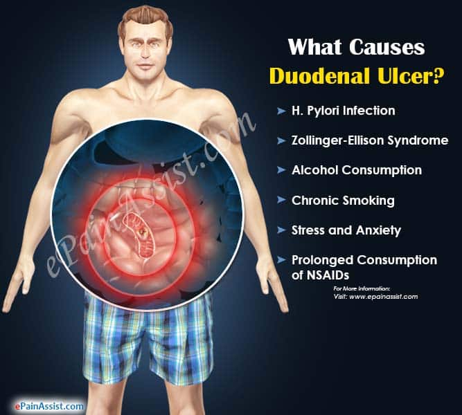 What Causes Duodenal Ulcer?