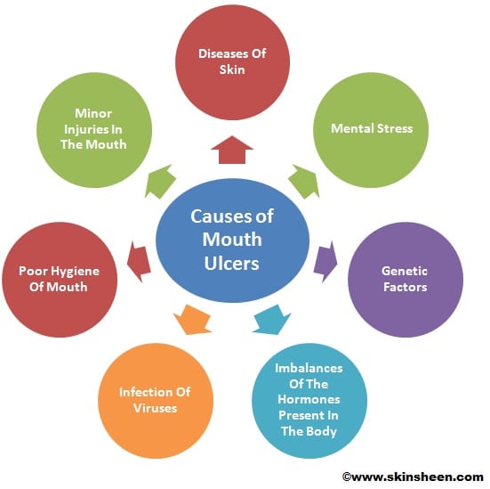 what causes mouth ulcer