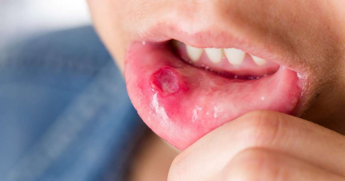 What Causes Mouth Ulcers (Canker sores) and How to Treat Them