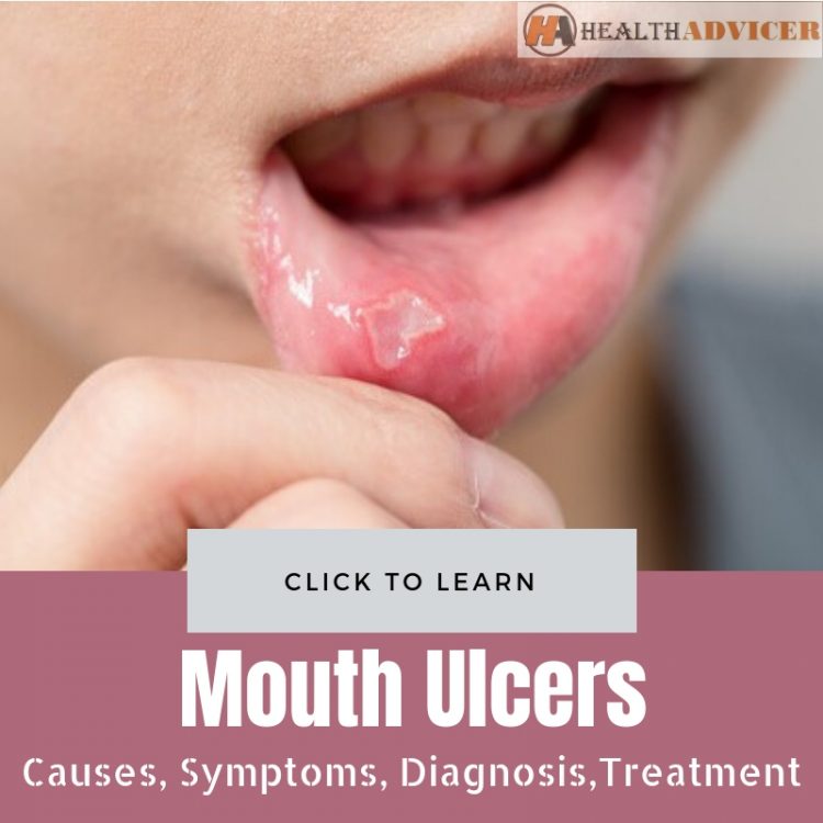 What Causes Mouth Ulcers / Glossitis Treatment In Homeopathy ...