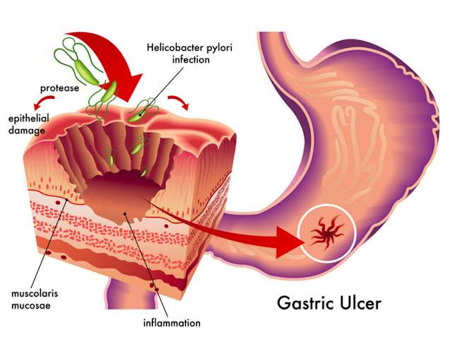 What Causes Stomach Ulcers?