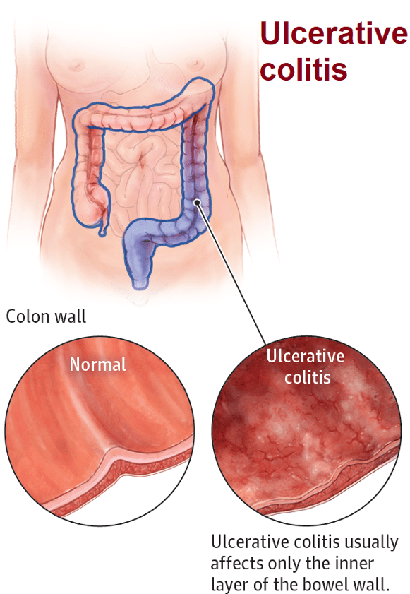 What difference between Uceris(extended