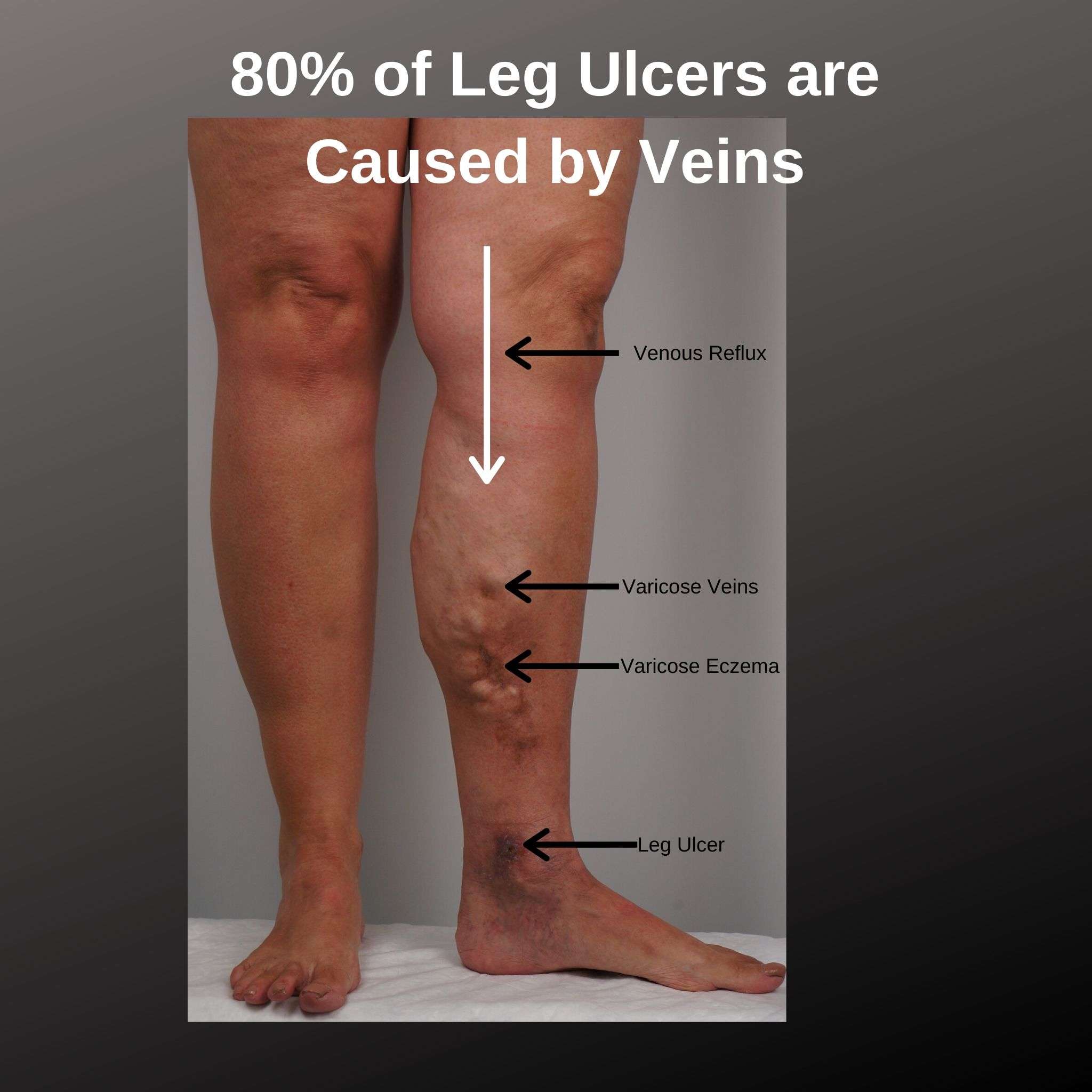 What do Leg Ulcers Look Like?