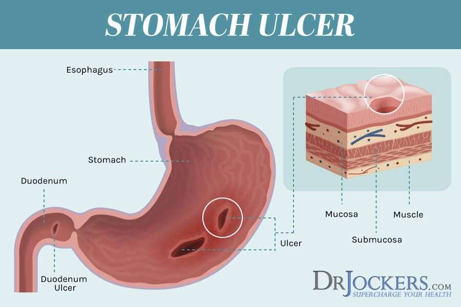 What Do Peptic Ulcers Feel Like
