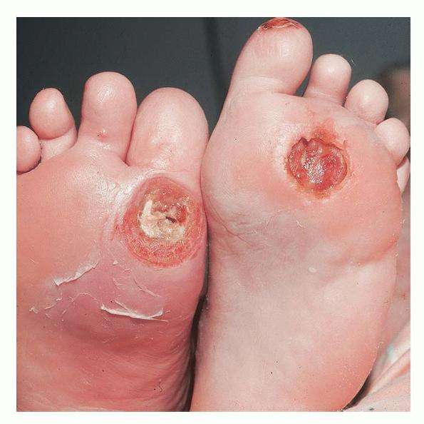 What does a diabetic ulcer on the bottom of your foot look like ...
