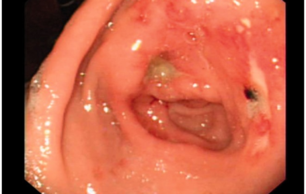 What Does a Stomach Ulcer Look Like?