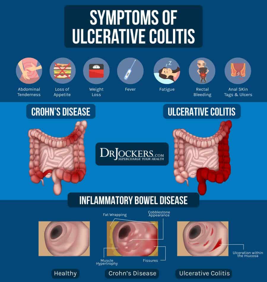 What Foods Flare Up Ulcerative Colitis
