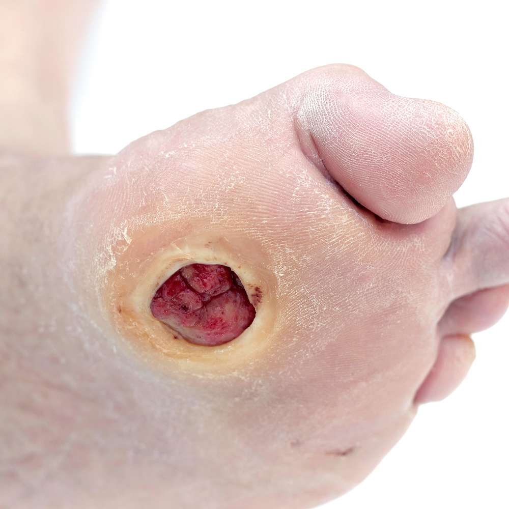 What is a diabetic foot ulcer